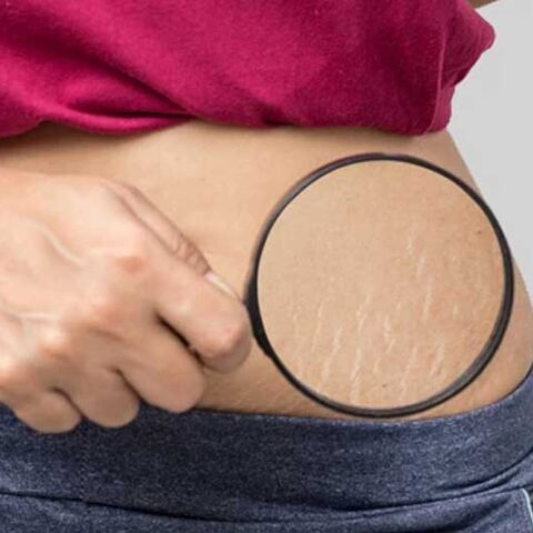 Scar and Stretch Marks Reduction