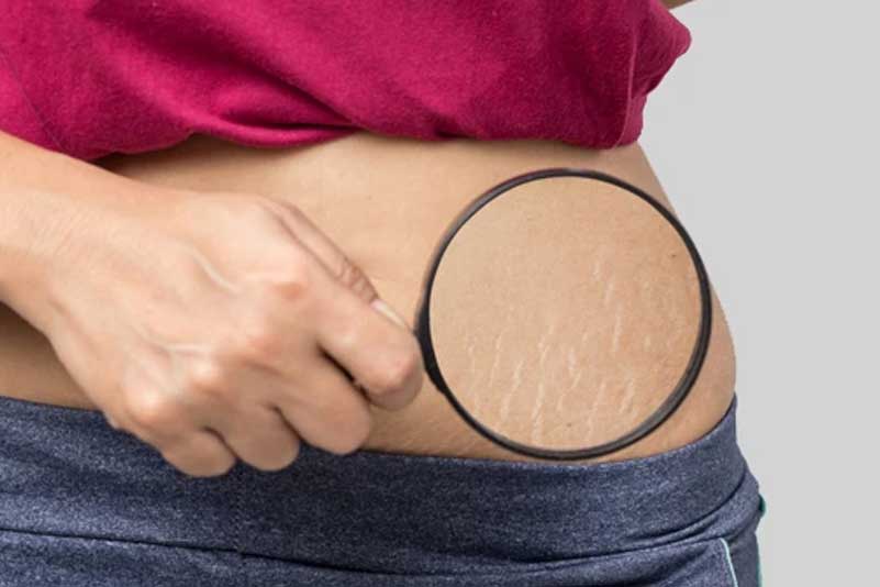 Scar and Stretch Marks Reduction